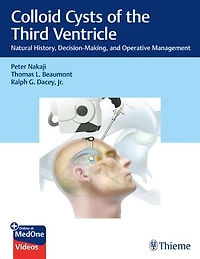 Colloid Cysts of the Third Ventricle: Natural History, Decision-Making, and Operative Management