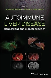 Autoimmune Liver Disease: Management And Clinical Practice
