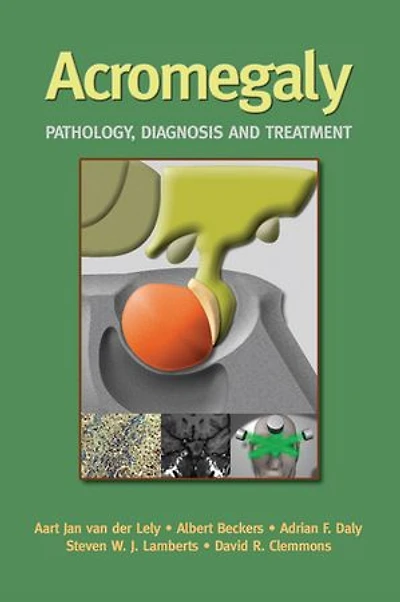 Acromegaly: Pathology, Diagnosis And Treatment