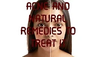 ACNE AND NATURAL REMEDIES TO TREAT IT