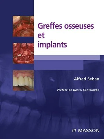 Greffes osseuses et implants