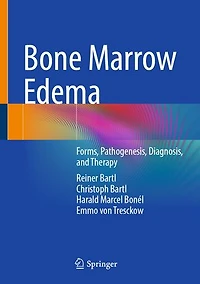 Bone Marrow Edema: Forms, Pathogenesis, Diagnosis, and Therapy