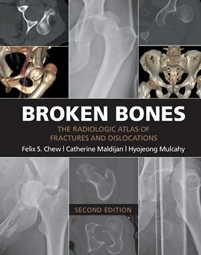 Broken Bones: The Radiologic Atlas of Fractures and Dislocations