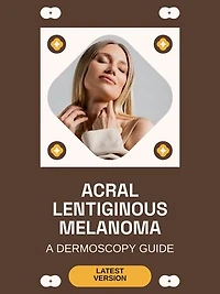 Acral Lentiginous Melanoma: A Dermoscopy Guide