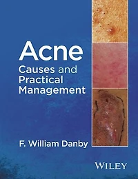 Acne: Causes and Practical Management