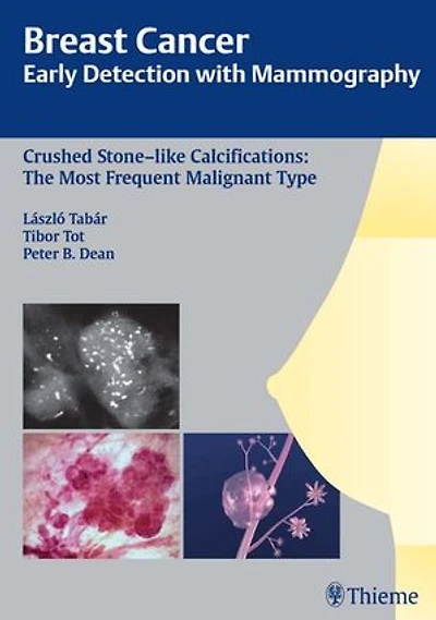 Breast Cancer: Early Detection with Mammography: Crushed Stone-like Calcifications: The Most Frequent Malignant Type