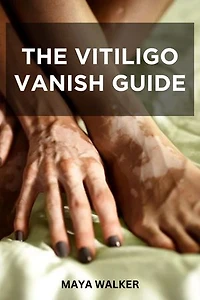 THE VITILIGO VANISH GUIDE: Essential Guide On Skin Pigmentation Improvement And Treating Vitiligo