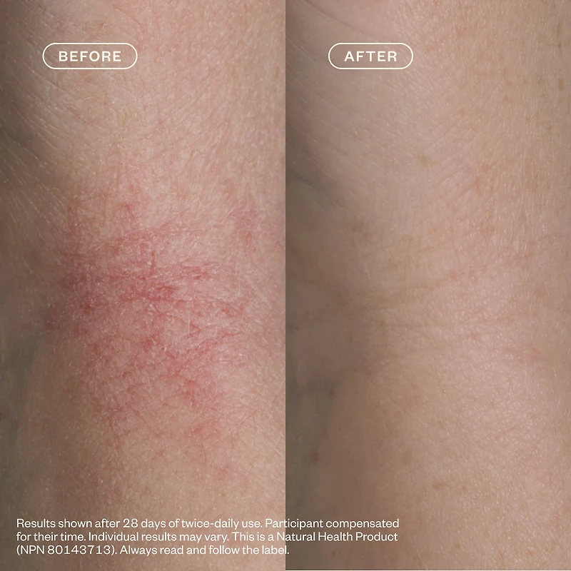 Eczema Cleanse & Comfort Ritual