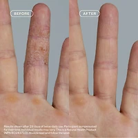 Dermedial™ Eczema+