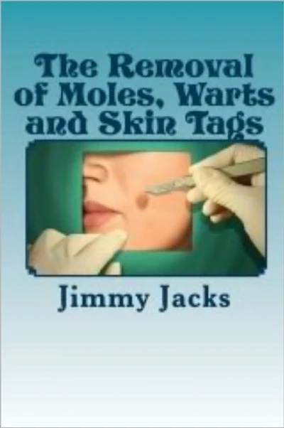The Removal of Moles, Warts and Skin Tags