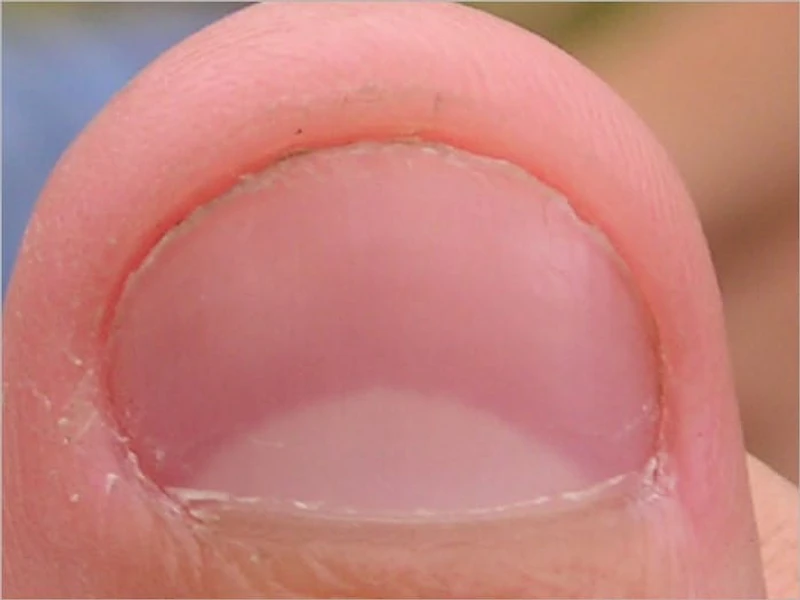 Nail Fungus Treatment: Safe and Natural Way to Banish Your Nail Fungus Forever