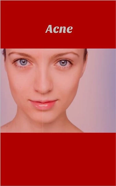 Know The Best Acne Solution For You