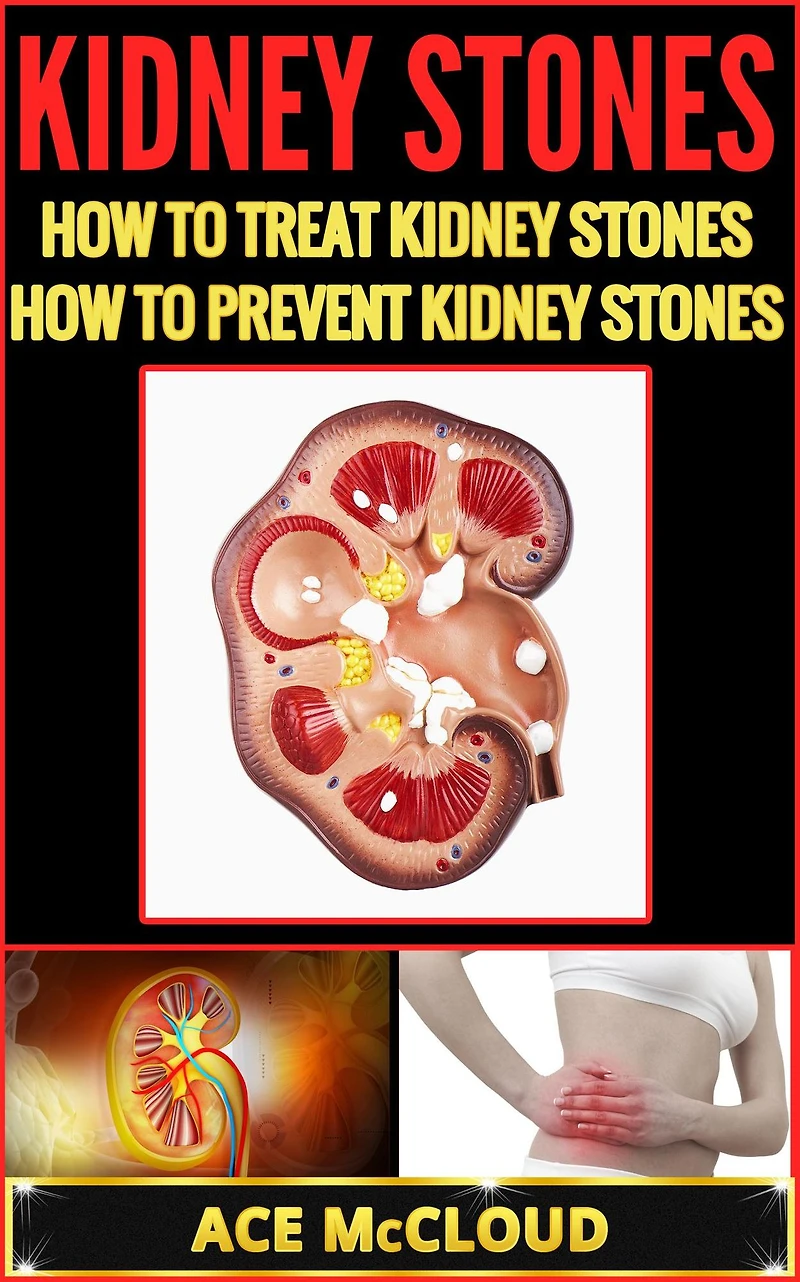 Kidney Stones: How To Treat Prevent Stones
