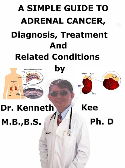 A Simple Guide to Adrenal Cancer, Diagnosis, Treatment and Related Conditions