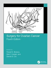 Surgery for Ovarian Cancer
