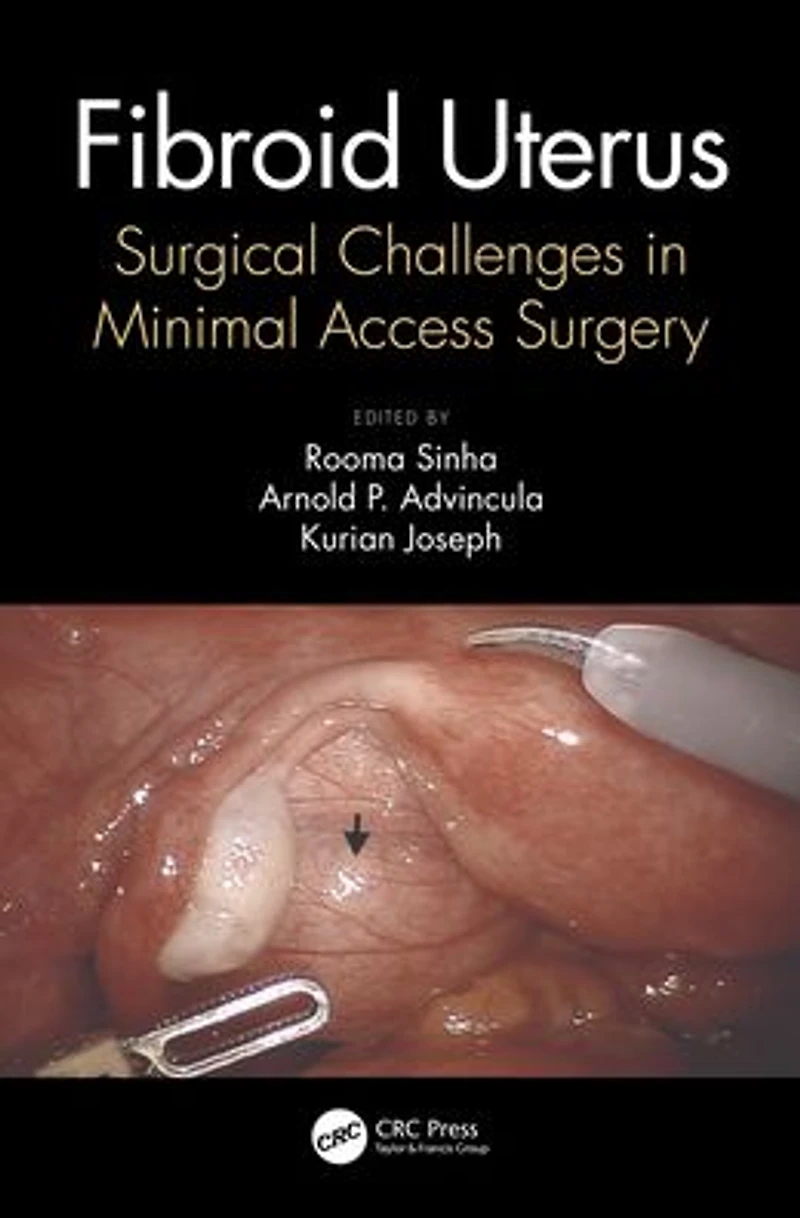 Fibroid Uterus: Surgical Challenges Minimal Access Surgery