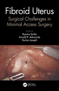Fibroid Uterus: Surgical Challenges Minimal Access Surgery