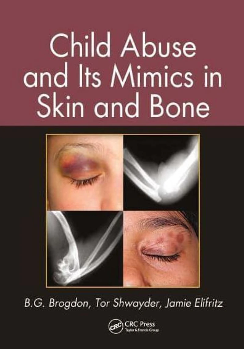 Child Abuse and its Mimics Skin Bone