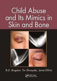 Child Abuse and its Mimics Skin Bone