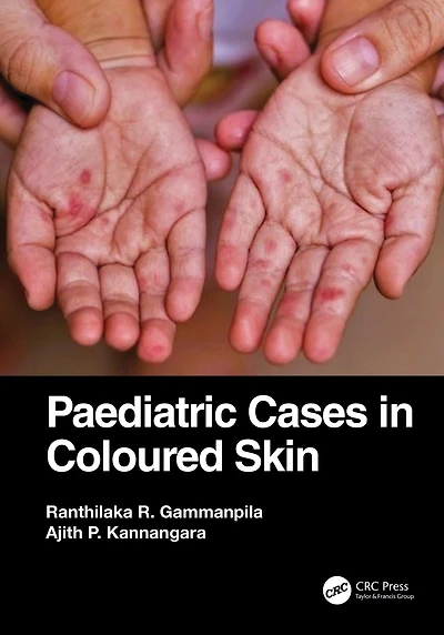 Paediatric Cases Coloured Skin