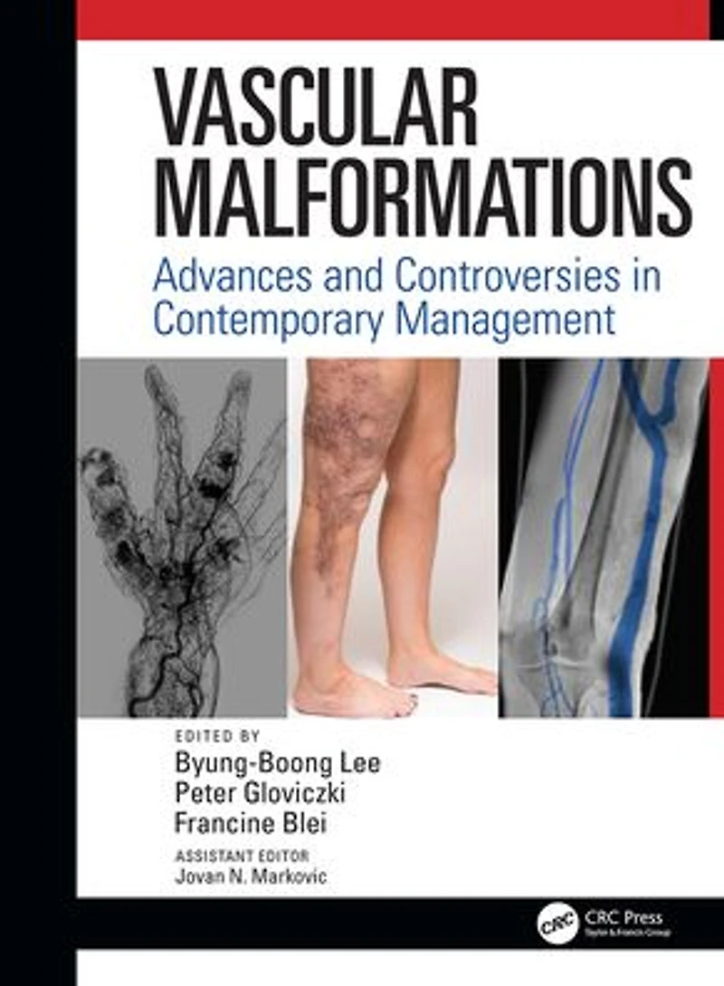 Vascular Malformations: Advances and Controversies Contemporary Management