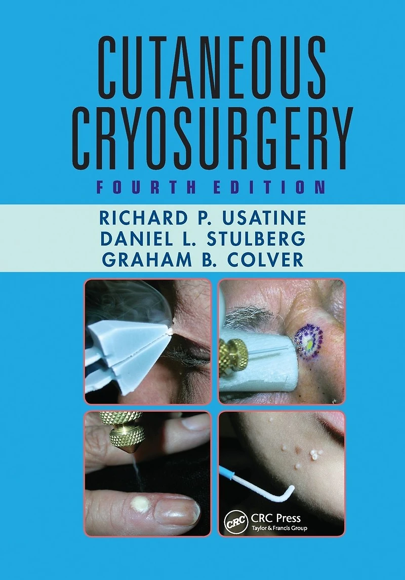 Cutaneous Cryosurgery