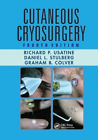Cutaneous Cryosurgery