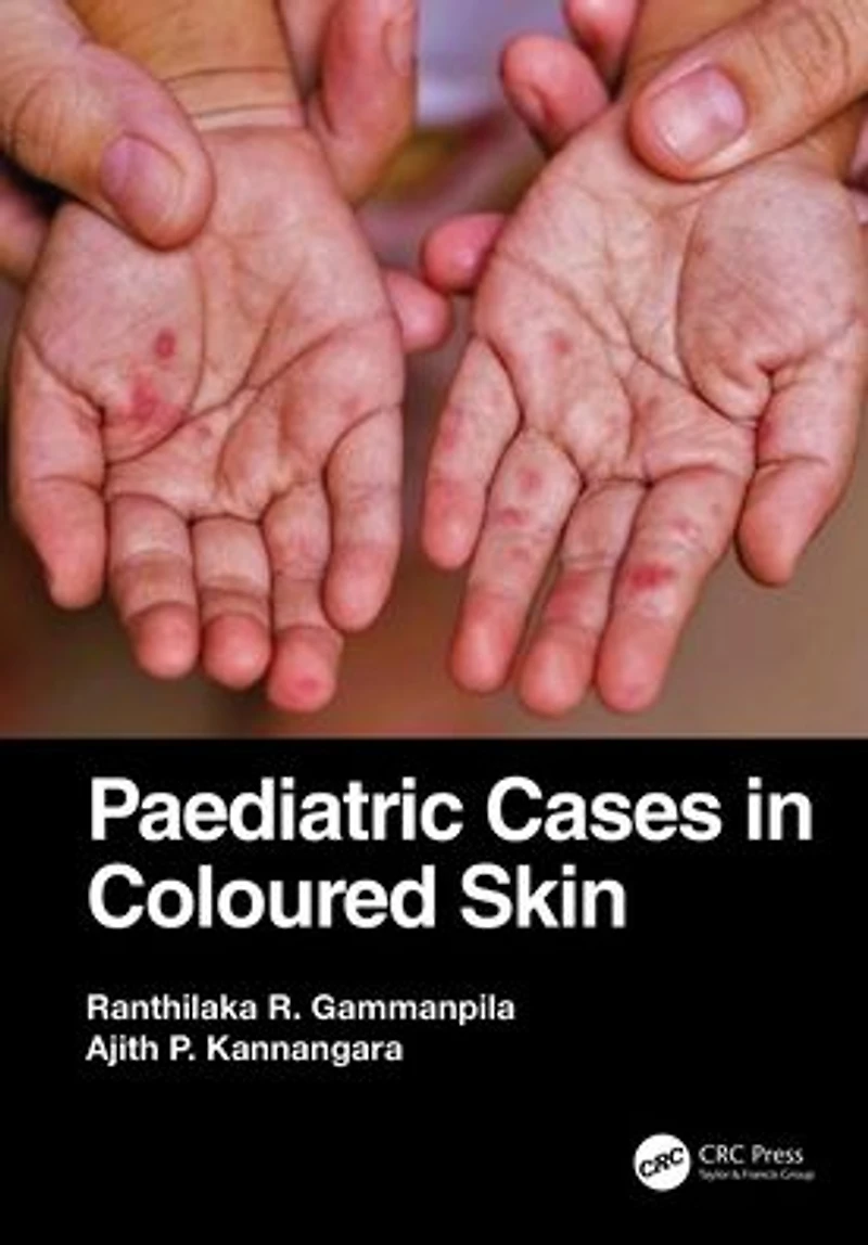 Paediatric Cases Coloured Skin