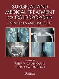 Surgical and Medical Treatment of Osteoporosis: Principles and Practice