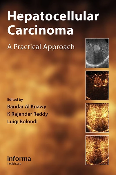 Hepatocellular Carcinoma: A Practical Approach