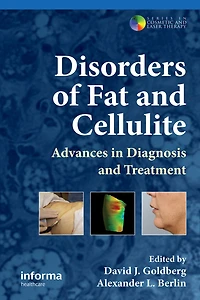 Disorders of Fat and Cellulite: Advances Diagnosis Treatment
