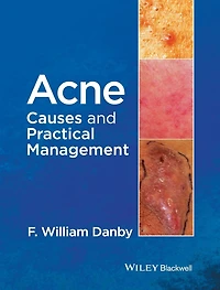 Acne: Causes and Practical Management