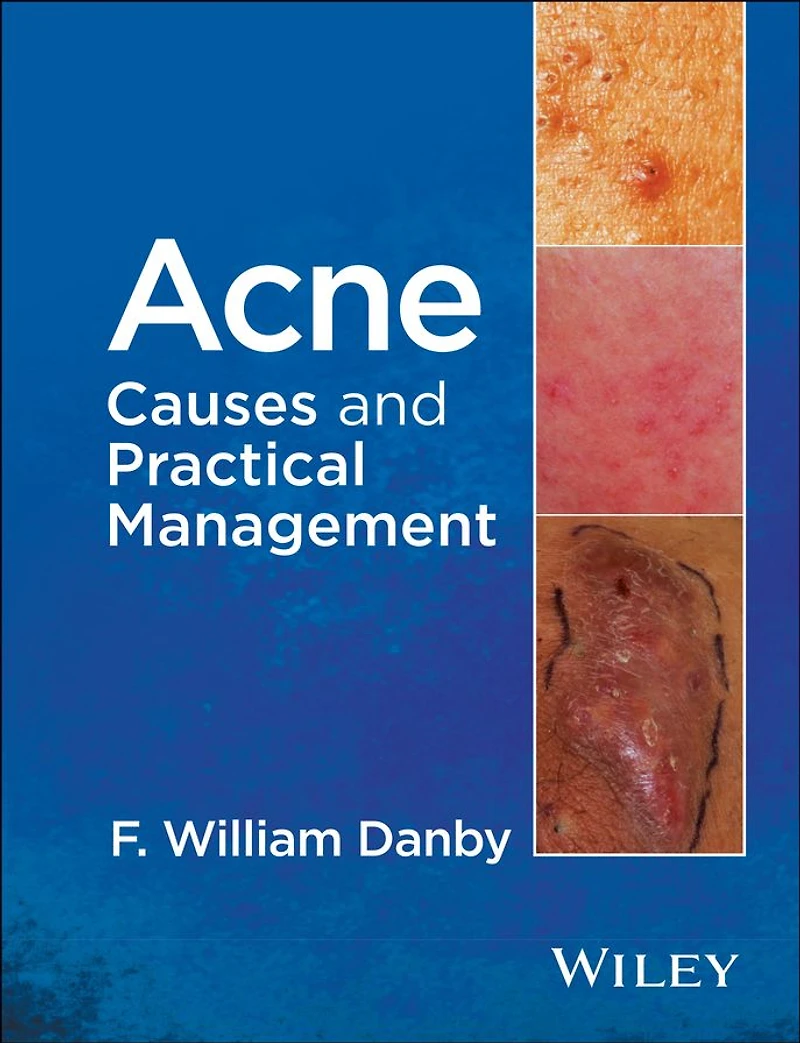 Acne: Causes and Practical Management