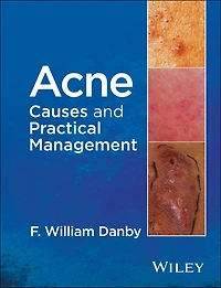 Acne: Causes and Practical Management
