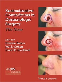 Reconstructive Conundrums in Dermatologic Surgery: The Nose