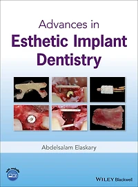 Advances Esthetic Implant Dentistry