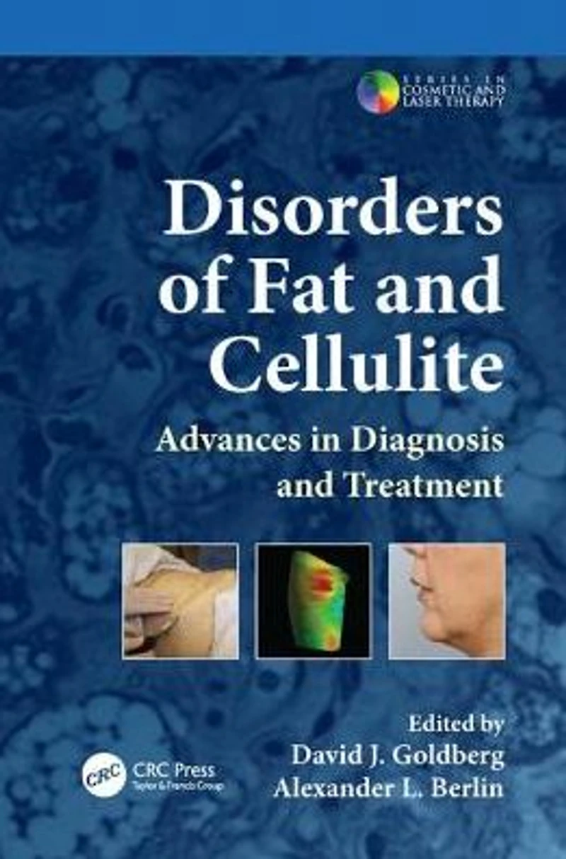 Disorders of Fat and Cellulite: Advances Diagnosis Treatment