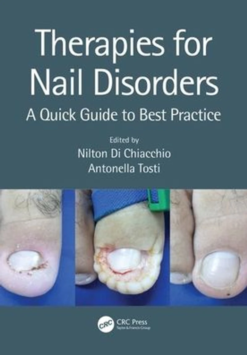 Therapies for Nail Disorders: A Quick Guide to Best Practice