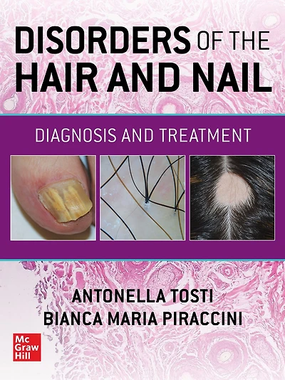 Disorders of the Hair and Nail: Diagnosis Treatment