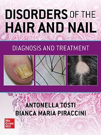 Disorders of the Hair and Nail: Diagnosis Treatment
