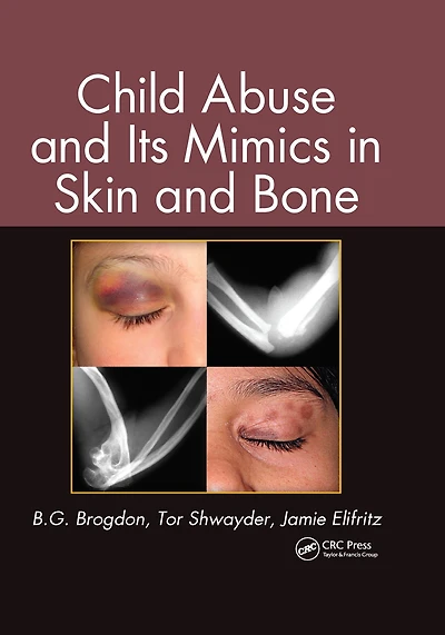 Child Abuse and its Mimics Skin Bone