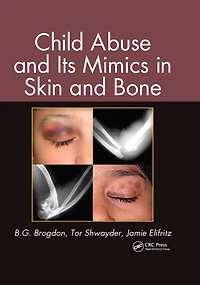 Child Abuse and its Mimics Skin Bone
