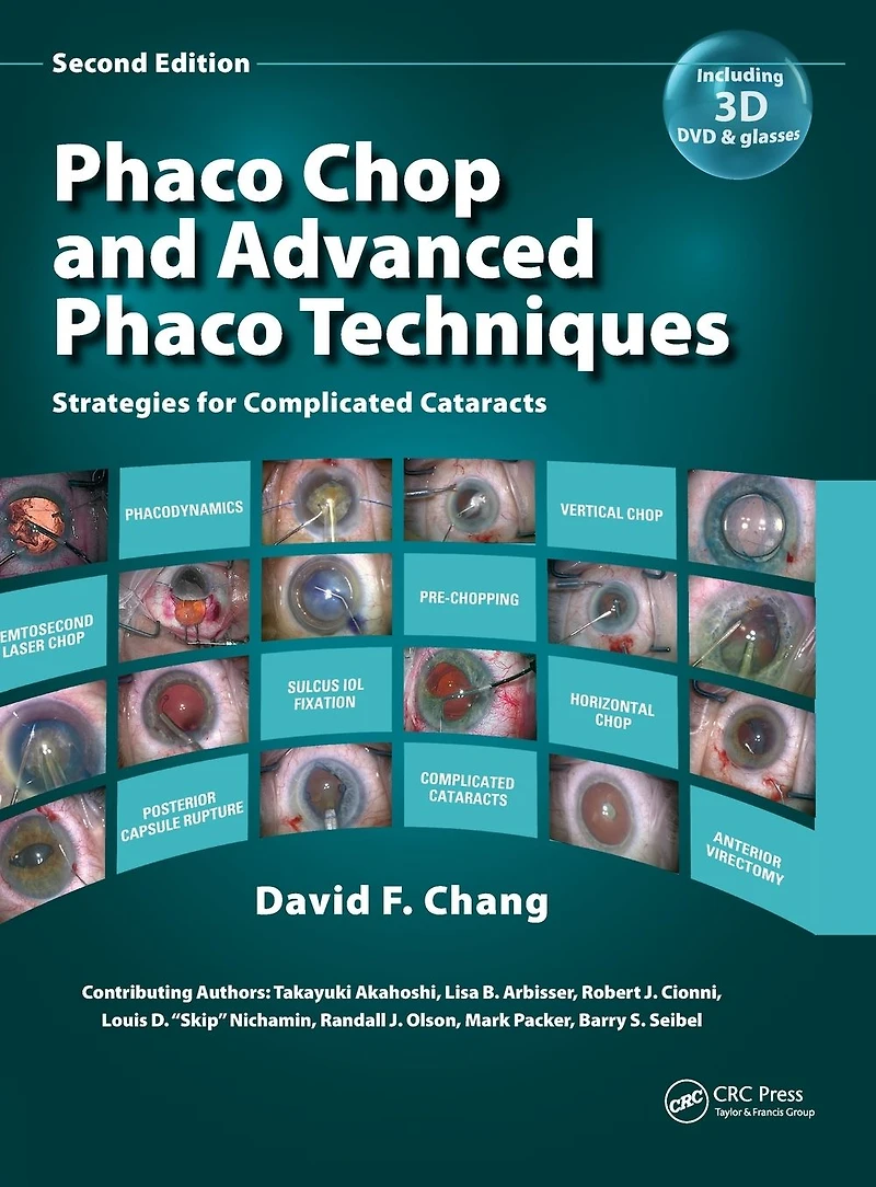Phaco Chop and Advanced Techniques: Strategies for Complicated Cataracts