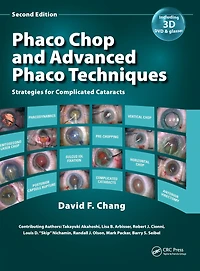 Phaco Chop and Advanced Techniques: Strategies for Complicated Cataracts