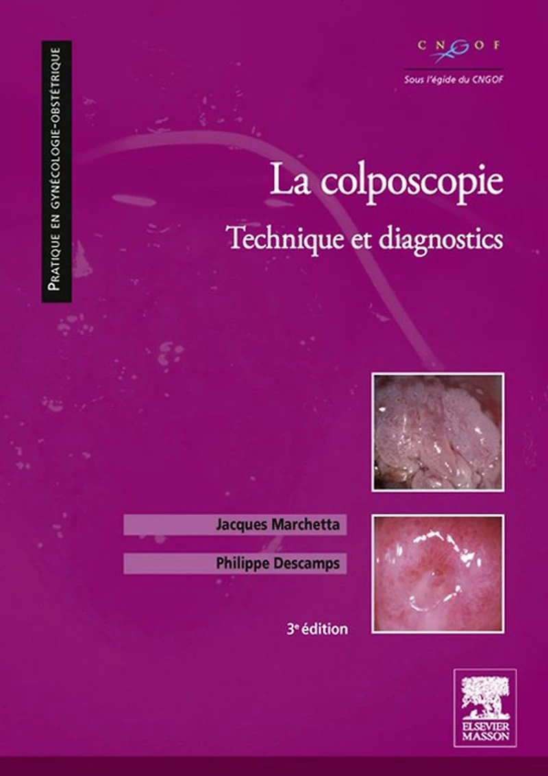 La colposcopie: Technique et diagnostics