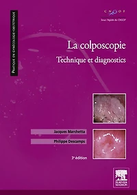 La colposcopie: Technique et diagnostics