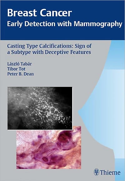Breast Cancer: Early Detection with Mammography: Casting-Type Calcifications: Sign of a Subtype with Deceptive Features