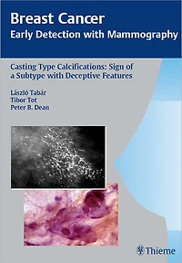 Breast Cancer: Early Detection with Mammography: Casting-Type Calcifications: Sign of a Subtype with Deceptive Features