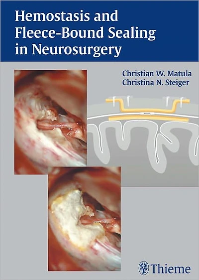 Hemostasis and Fleece-Bound Sealing in Neurosurgery