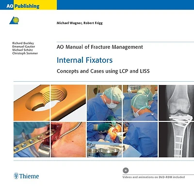 AO Manual of Fracture Management: Internal Fixators: Concepts and Cases using LCP and LISS